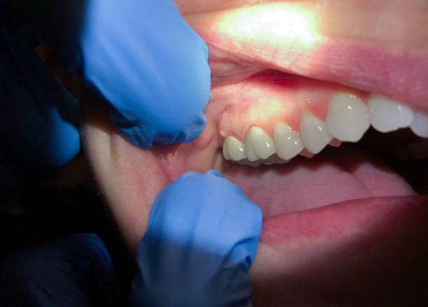 Best Emergency Dentist for Lost Fillings or Crowns in Williamstown, WV